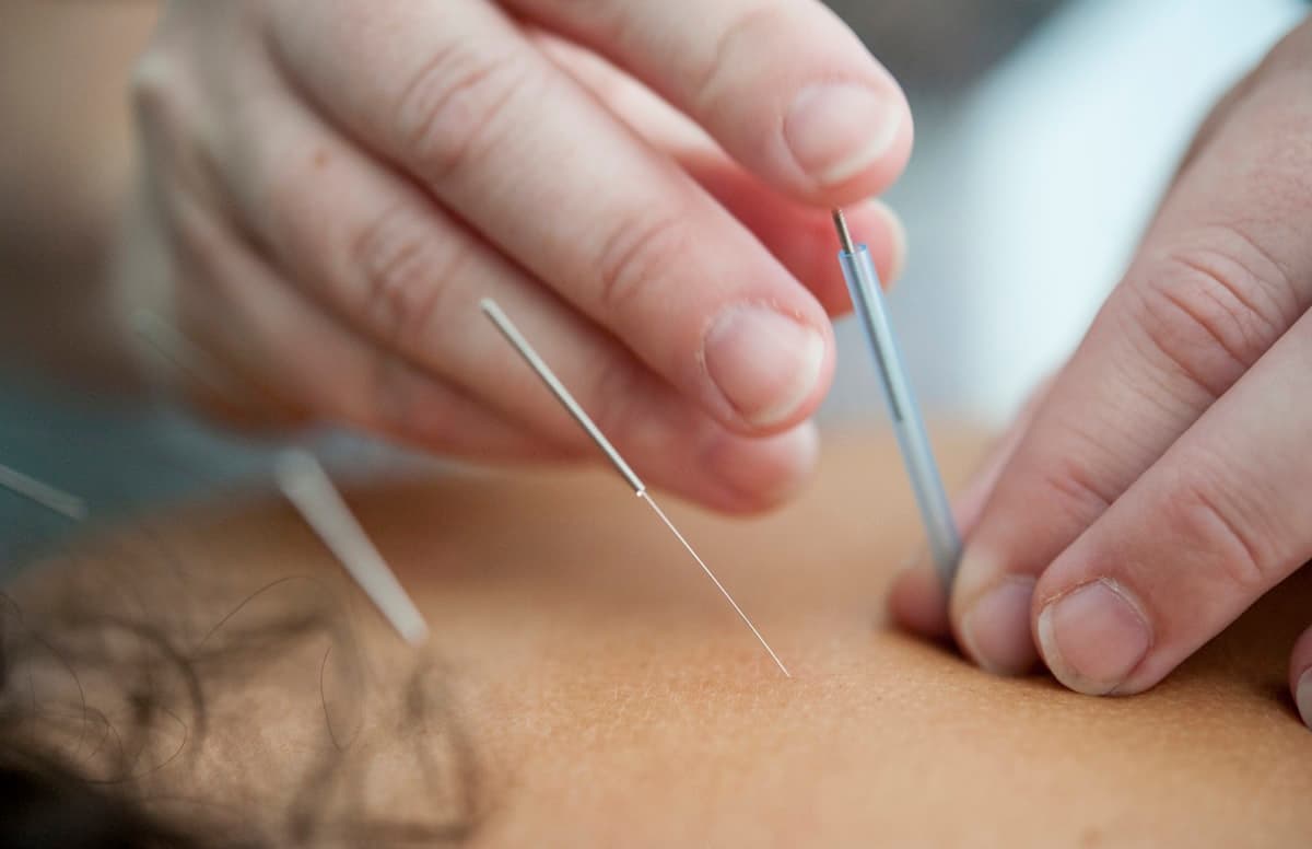 Traditional Acupuncture
